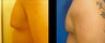 Male Breast Reconstruction