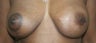 Breast Reconstruction