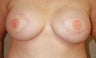 Breast Reconstruction