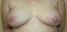 Breast Reconstruction