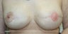 Revision of Reconstructed Breast