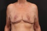 Breast reconstruction