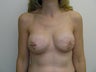 Bilateral Breast Reconstruction with Implants and Allograft