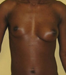 Brest Reconstruction With Natural Fat