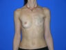 Breast Reconstruction