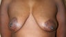 Breast Reconstruction