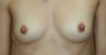 Breast Reconstruction