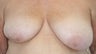 Breast Reconstruction