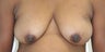 Breast Reconstruction