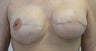Revision of Reconstructed Breast