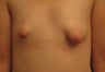Reconstruction of Tubular Breast Deformity