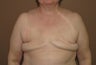 Bilateral reconstruction of the breast with expanders/implants