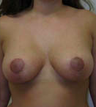 Breast Reduction