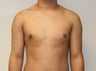 Male Breast Reduction