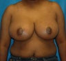FEMMA-S Breast reduction and lift