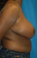 FEMMA-S Breast reduction and lift