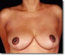 Breast Reduction