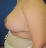 Breast Reduction