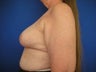 Breast Reduction