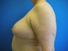Breast Reduction