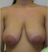 Breast Reduction