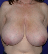Breast Reduction