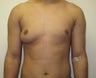 Male Breast Reduction