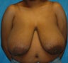 FEMMA-S Breast reduction and lift