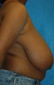 FEMMA-S Breast reduction and lift