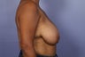 Breast Reduction