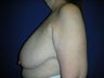 Breast Reduction