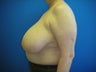 Breast Reduction