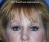 Upper and lower blepharoplasty