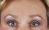 Endoscopic Brow lift