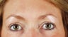 Endoscopic brow lift and blepharoplasty