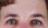 Endoscopic brow lift and upper blepharoplasty