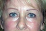 Endoscopic Brow Lift