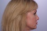 Endoscopic Brow Lift