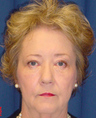 Brow Lift