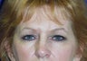 Upper and lower blepharoplasty