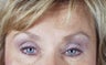 Endoscopic Brow lift