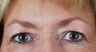 Endoscopic brow lift and blepharoplasty