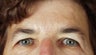 Endoscopic brow lift and upper blepharoplasty