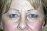 Endoscopic Brow Lift
