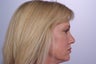 Endoscopic Brow Lift