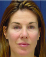 Brow Lift