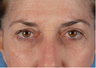 Browlift and Upper/Lower Eyes