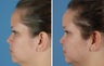 Endoscopic Brow Lift