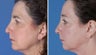 Endoscopic Browlift and Upper and Lower Eyelid Surgery