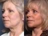 Brow Lift
